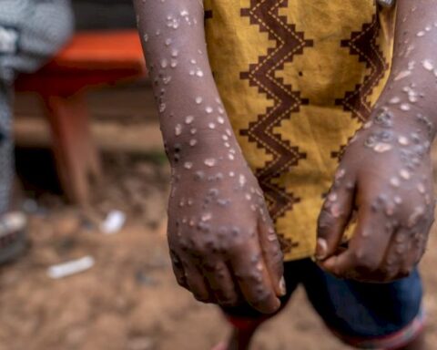 congo’s-refugee-camps-face-severe-mpox-outbreak