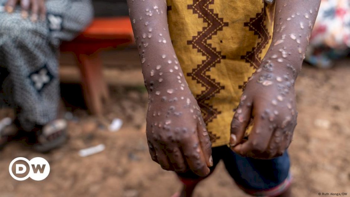 congo’s-refugee-camps-face-severe-mpox-outbreak